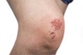 Woman scratch skin on the knee. Injury concept