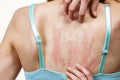 Woman scratching her itchy back with allergy rash Royalty Free Stock Photo