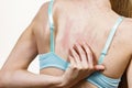 Woman scratching her itchy back with allergy rash Royalty Free Stock Photo