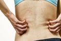 Woman scratching her itchy back with allergy rash Royalty Free Stock Photo