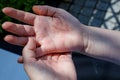 Woman scratching itchy hand, Concept, Atopic dermatitis, Red hands, Dermatological problem Royalty Free Stock Photo