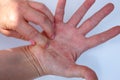 Woman Scratching Itchy Hands, Atopic Dermatitis, Red Hand, Dermatological Problem, Sensitization, Minimal Concept, White Royalty Free Stock Photo