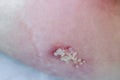 Woman with Shingles or Herpes Zoster on skin, it is raised red bumps and blisters caused on body. Medicine treatment for varicella Royalty Free Stock Photo