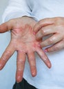Atopic dermatitis, Red, itchy hands with blisters and chapped skin Royalty Free Stock Photo