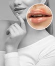 Woman showing herpes disease on her lips. Treatment of viral infections