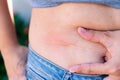 Woman showing a scar on her belly, up close. Concept of medical care