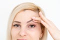 woman shows drooping eyelid for plastic surgery Royalty Free Stock Photo