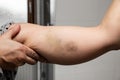 woman shows a large bruise on her arm Royalty Free Stock Photo
