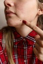 Woman shows a pimple with her finger Royalty Free Stock Photo