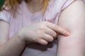 Woman shows the vaccination mark on her shoulder with her finger