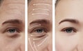 Woman skin face wrinkles effect surgery contrast results correction before and after procedures, arrow Royalty Free Stock Photo