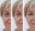 Woman skin face wrinkles effect surgery results correction before and after procedures, arrow Royalty Free Stock Photo