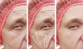 Woman skin face wrinkles surgery contrast patient results correction before and after procedures, arrow Royalty Free Stock Photo