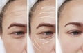 Woman skin face wrinkles surgery contrast results correction before and after procedures, arrow Royalty Free Stock Photo