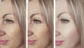 Woman skin wrinkles removal before after collage cosmetology regeneration treatments contrast Royalty Free Stock Photo