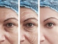 Woman skin wrinkles removal before cosmetology after collage cosmetology regeneration treatments contrast Royalty Free Stock Photo