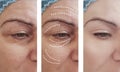 Woman skin wrinkles removal before difference cosmetology after collage cosmetology regeneration treatments contrast Royalty Free Stock Photo