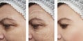 Woman skin wrinkles removal medicine patient regeneration difference after collage cosmetology regeneration contrast Royalty Free Stock Photo