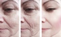 Woman skin wrinkles removal medicine before regeneration difference after collage cosmetology regeneration treatments contrast Royalty Free Stock Photo