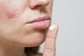 Woman smears her sores on lips with ointment from herpes infection, closeup. Manifestation of the herpes virus on the female lips