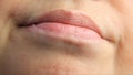 Woman with sores from herpes on her lips, herpes. lip treatment. 4k, slow-motion shooting, copy space