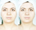 Woman with spotty skin with cicatrices and wrinkles and healed
