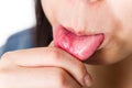 Woman suffer from mouth aphtha
