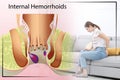 Woman suffering from hemorrhoid pain on sofa at home. Illustration of unhealthy lower rectum