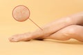 Woman suffering from varicose veins on pastel gold background, closeup. Magnified skin surface showing affected area