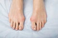 The woman suffers from inflammation of the big toe bone. Hallux valgus, bunion in foot on white background. Royalty Free Stock Photo