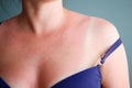 Woman with sunburned skin. Burn