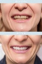 Woman teeth before and after dental treatment. Happy smiling woman. Dental health concept, oral care, teeth