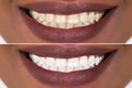 Woman Teeth Before And After Whitening Royalty Free Stock Photo