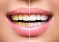 Woman teeth before and after whitening Royalty Free Stock Photo