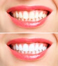 Woman teeth before and after whitening. Over white background. Dental clinic patient. Image symbolizes oral care Royalty Free Stock Photo