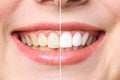 Woman teeth before and after whitening. Over white background. Dental clinic patient. Image symbolizes oral care Royalty Free Stock Photo