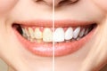 Woman teeth before and after whitening. Over white background. Dental clinic patient. Image symbolizes oral care Royalty Free Stock Photo