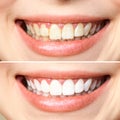 Woman teeth before and after whitening. Over white background. Dental clinic patient. Image symbolizes oral care Royalty Free Stock Photo