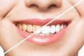 Woman teeth before and after whitening. Over white background. Dental clinic patient. Image symbolizes oral care