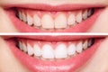 Woman teeth before and after whitening. Over white background. Dental clinic patient. Image symbolizes oral care