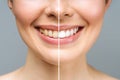 woman teeth before and after whitening. Over white background. Dental clinic patient. Image symbolizes oral care Royalty Free Stock Photo