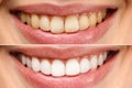 woman teeth before and after whitening. Over white background. Dental clinic patient. Image symbolizes oral care Royalty Free Stock Photo