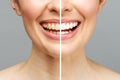 woman teeth before and after whitening. Over white background. Dental clinic patient. Image symbolizes oral care Royalty Free Stock Photo