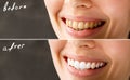 woman teeth before and after whitening. Over white background. Dental clinic patient. Image symbolizes oral care Royalty Free Stock Photo