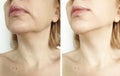 Woman tightening the chin correction collage before and after the procedure treatment Royalty Free Stock Photo