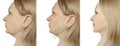 Woman tightening the chin correction sagging collage before and after the procedure treatment Royalty Free Stock Photo