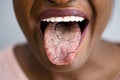 Woman Tongue With Bad Bacteria Candidiasis