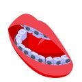 Woman tooth braces icon, isometric style