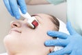 Woman undergoes the procedure of medical micro needle therapy with a modern medical instrument derma roller