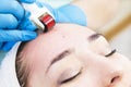 Woman undergoes the procedure of medical micro needle therapy with a modern medical instrument derma roller